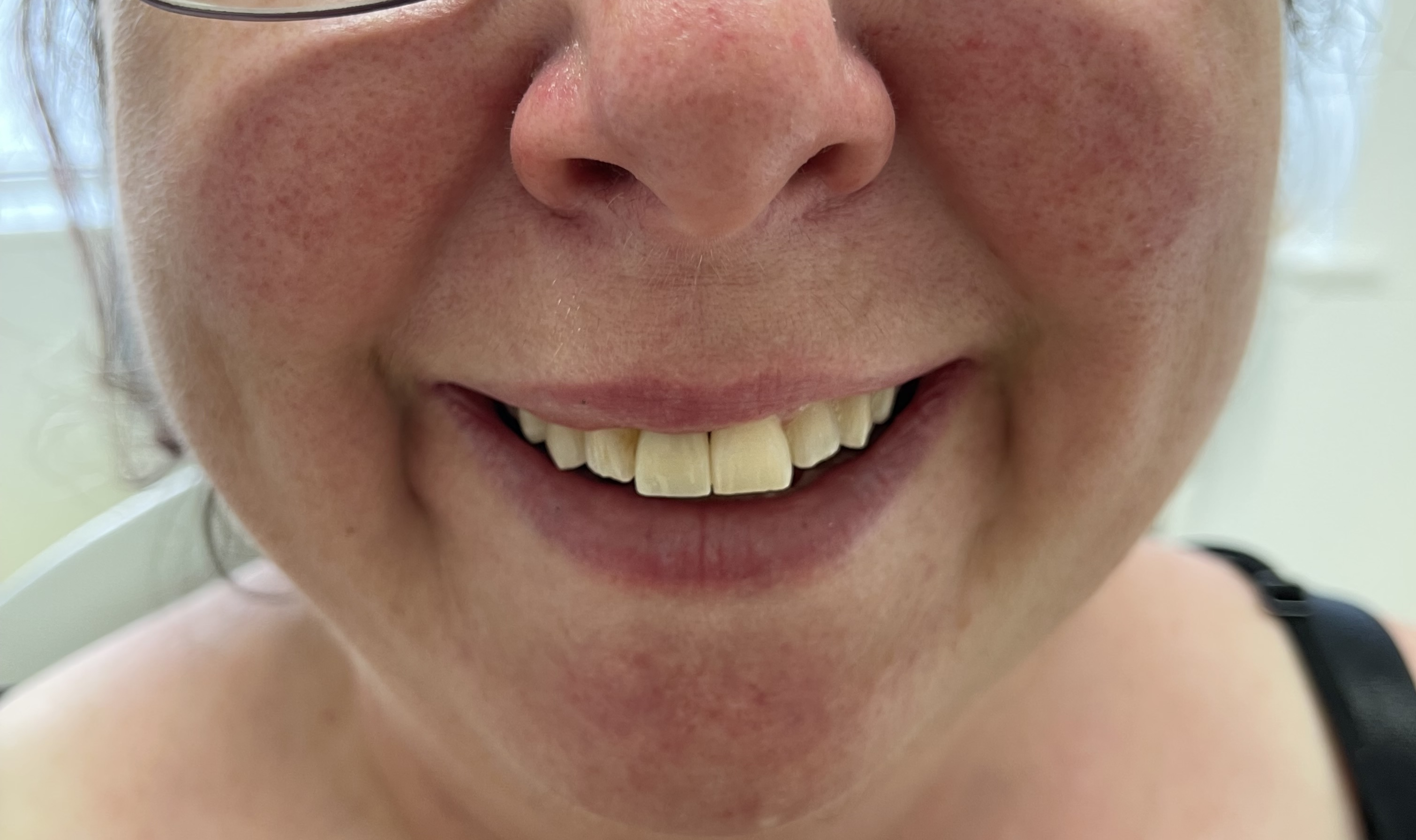 After dental implant treatment