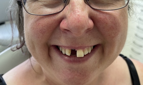 Before dental implant treatment