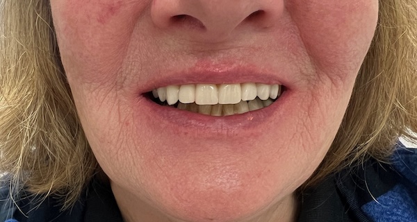 After dental implant treatment