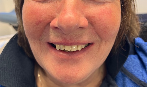 Before dental implant treatment
