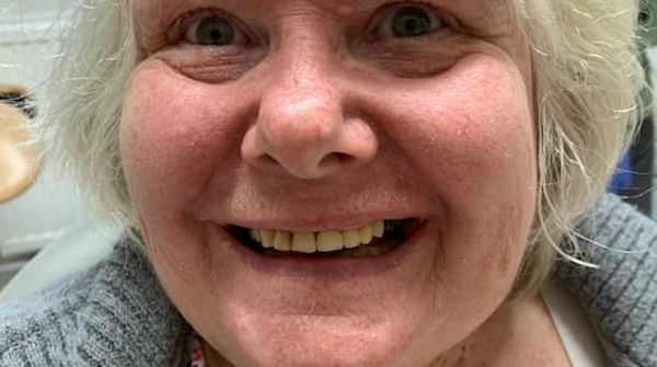 After dental implant treatment